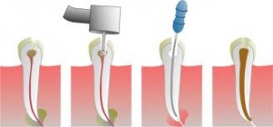 leczenie lanalowe - dobry dentysta warszawa