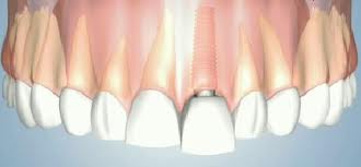 implanty zębowe warszawa praga