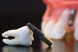 Implanty zębowe warszawa praga